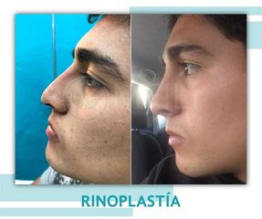 Rinoplastia - Clinica Meili