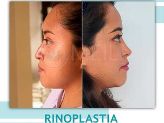 Rinoplastia antes y después - 871343