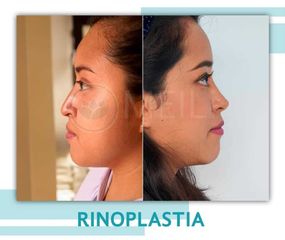 Rinoplastia - Clinica Meili