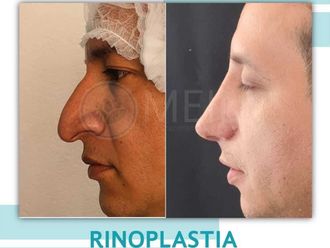 Rinoplastia antes y después - 871344