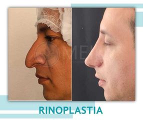 Rinoplastia - Clinica Meili