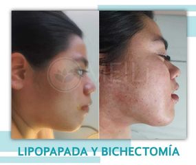 Lipopapada - Clinica Meili