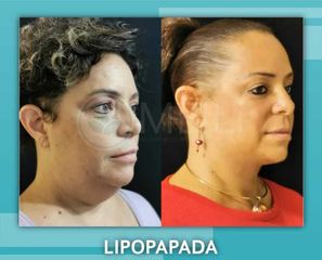 Lipopapada - Clinica Meili