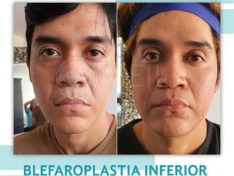 Blefaroplastia antes y después - 871348