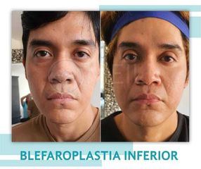 Blefaroplastia - Clinica Meili