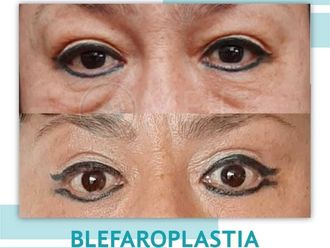 Blefaroplastia antes y después - 871349