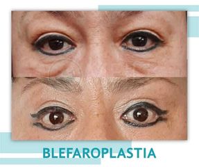 Blefaroplastia - Clinica Meili