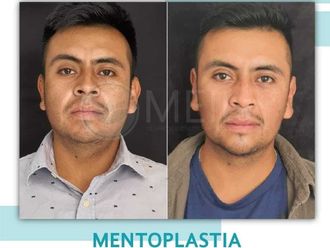 Mentoplastia antes y después - 871350