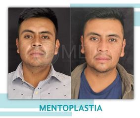 Mentoplastia - Clinica Meili