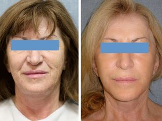 Antes y después de Lifting facial