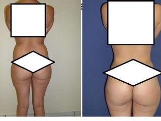 Antes y después de Lipposucción