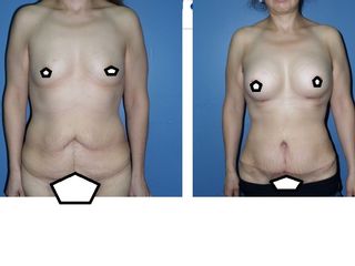 Antes y después de Mommy Makeover