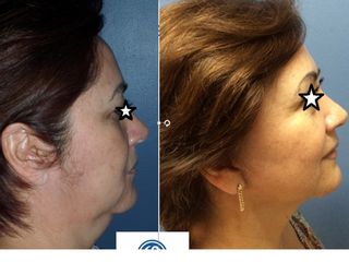 Antes y después de Lifting cuello y facial