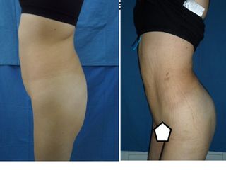 Antes y después de Lipoescultura