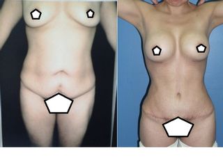 Antes y después de Mommy Makeover