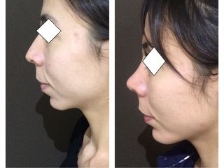 Antes y después de  Armonización facial, rinoplastia, mentón y mejillas