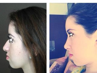 Antes y después de Cirugía facial