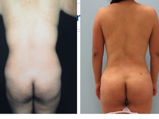 Antes y después de Liposucción y aumento glúteo