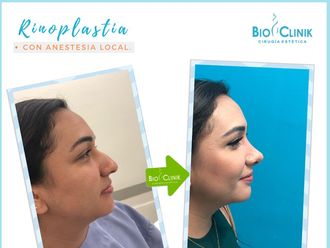 Rinoplastia - 634794