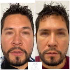 Eliminación de ojeras - Dr. Eduardo Cartagena