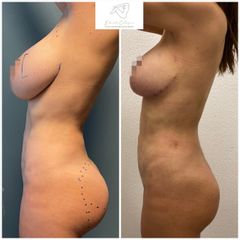Mastopexia - Dr. Eduardo Cartagena