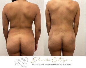 Liposucción - Dr. Eduardo Cartagena