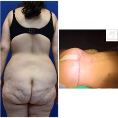 Abdominoplastia - Dr. Eduardo Cartagena