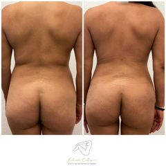Liposucción - Dr. Eduardo Cartagena