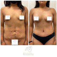 Lipoescultura - Dr. Eduardo Cartagena