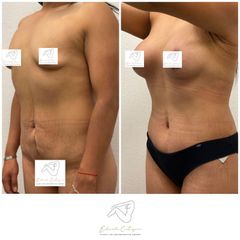 Lipoescultura - Dr. Eduardo Cartagena