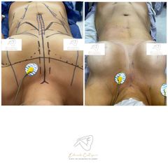 Aumento de busto - Dr. Eduardo Cartagena