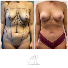 Mommy makeover - Dr. Eduardo Cartagena