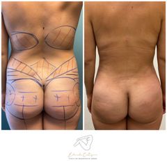 Mommy makeover - Dr. Eduardo Cartagena