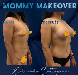 Mommy makeover - Dr. Eduardo Cartagena