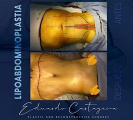 Abdominoplastia - Dr. Eduardo Cartagena