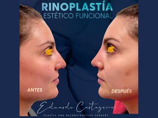 Rinoplastia - Dr. Eduardo Cartagena