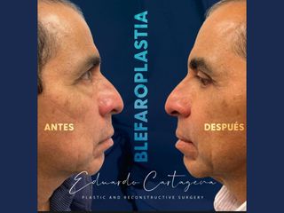 Blefaroplastia - Dr. Eduardo Cartagena