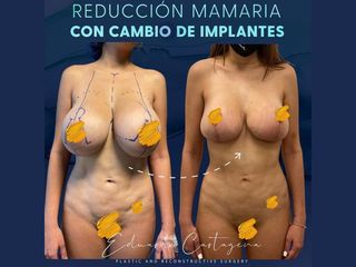 Reducción de mamas - Dr. Eduardo Cartagena