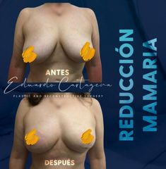 Reduccion mamaria - Dr. Eduardo Cartagena