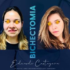 Bichectomia - Dr. Eduardo Cartagena