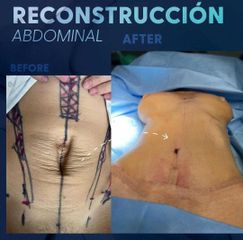 Abdominoplastia - Dr. Eduardo Cartagena