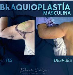 Braquioplastia Masculina - Dr. Eduardo Cartagena