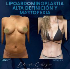 Lipoabdomino y Mastopexia - Dr. Eduardo Cartagena