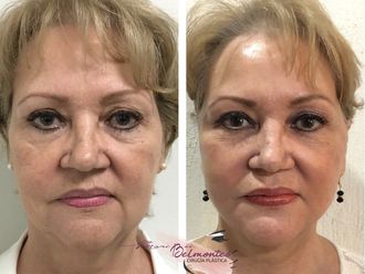 Lifting antes y después - 648858