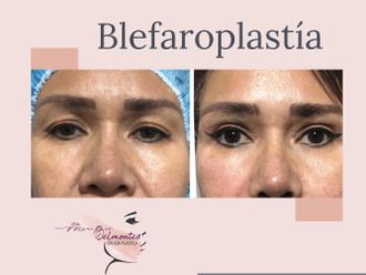 Blefaroplastia antes y después - 648891