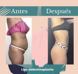 Lipoabdomindoplastia - Dr. Fernando Gallardo García