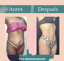 Lipoabdomindoplastia - Dr. Fernando Gallardo García