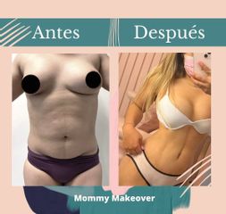 Mommy Makeover - Dr. Fernando Gallardo García