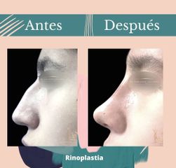 Rinoplastia - Dr. Fernando Gallardo García