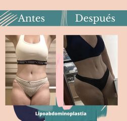 Lipoabdomindoplastia - Dr. Fernando Gallardo García